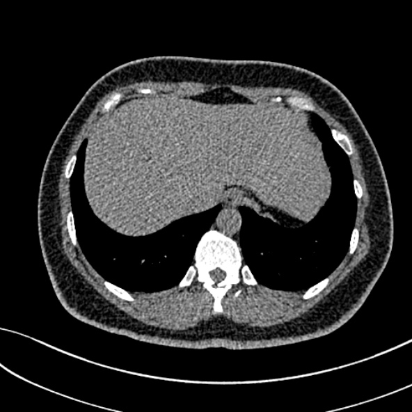 Normal CT chest- adult female (Radiopaedia 52522-58428 Axial non-contrast 109).jpg