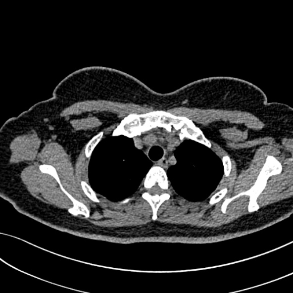 Normal CT chest- adult female (Radiopaedia 52522-58428 Axial non-contrast 28).jpg