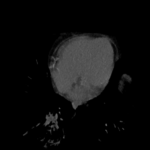 File:Normal CT intravenous cholangiogram (Radiopaedia 38199-40208 Axial IVC (MIP) 97).png