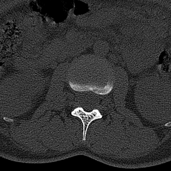 File:Normal CT lumbar spine (Radiopaedia 53981-60118 Axial bone window 27).jpg