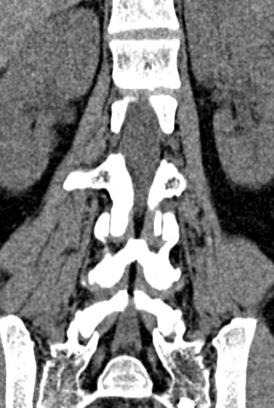 Normal CT lumbar spine (Radiopaedia 53981-60118 F 57).jpg