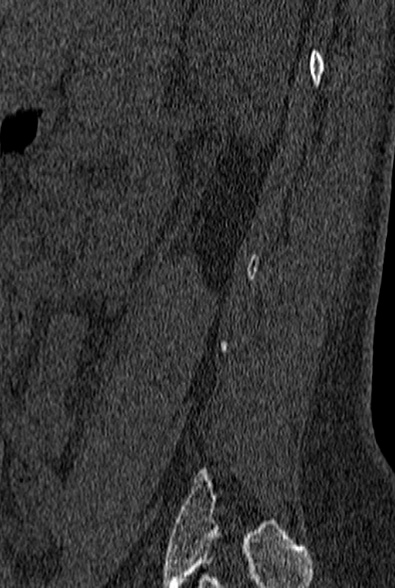 File:Normal CT lumbar spine (Radiopaedia 53981-60118 Sagittal bone window 84).jpg