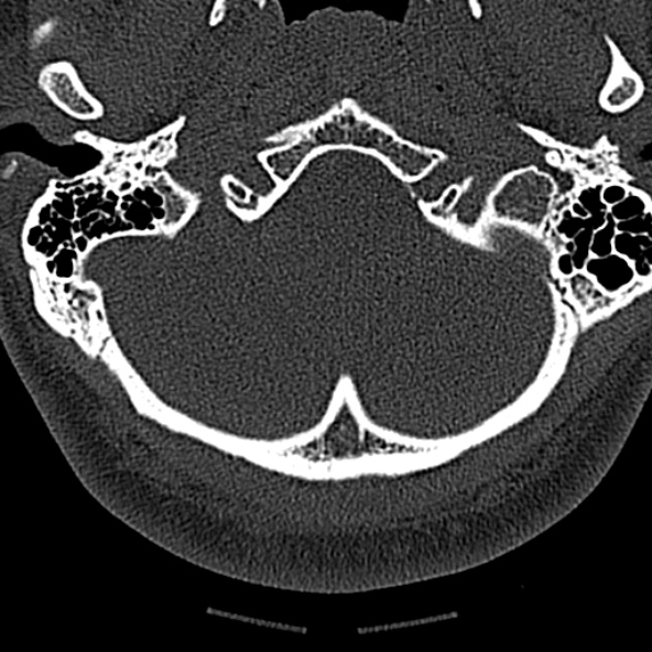 Normal CT of the cervical spine (Radiopaedia 53322-59305 Axial bone window 28).jpg