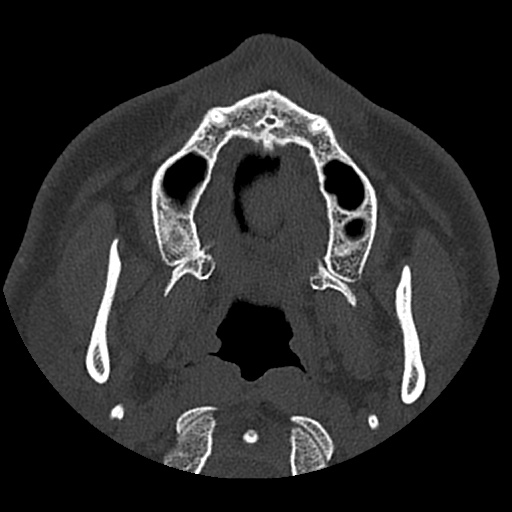 Normal CT paranasal sinuses (Radiopaedia 42286-45390 Axial bone window 96).jpg