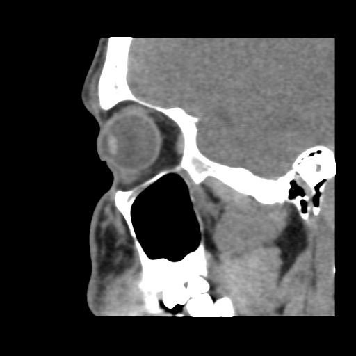 Normal CT paranasal sinuses (Radiopaedia 42286-45390 F 108).jpg