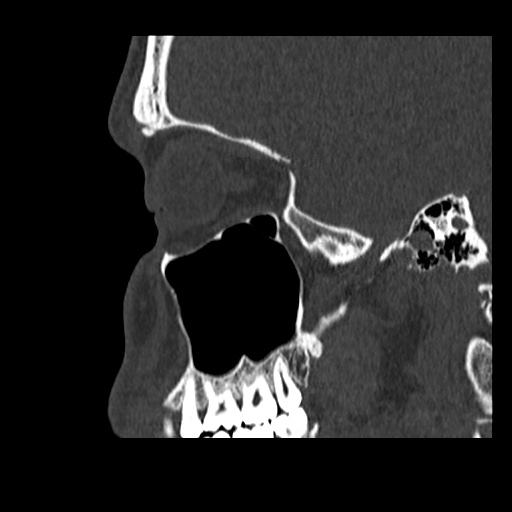 Normal CT paranasal sinuses (Radiopaedia 42286-45390 Sagittal bone window 76).jpg