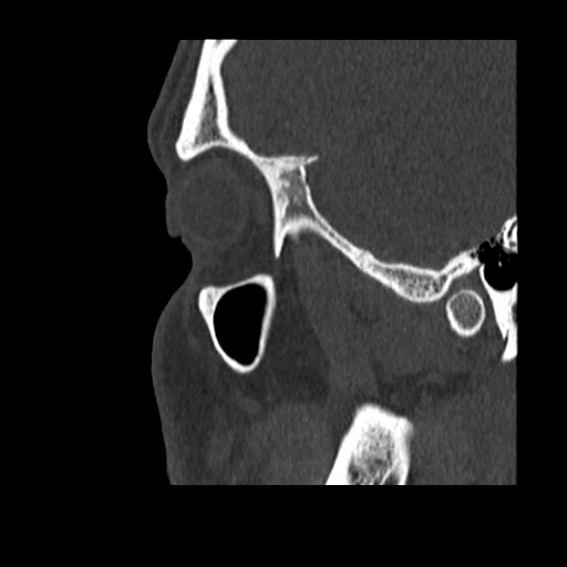 Normal CT paranasal sinuses (Radiopaedia 42286-45390 Sagittal bone window 90).jpg