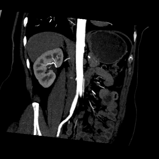 File:Normal CT renal artery angiogram (Radiopaedia 38727-40889 D 11).png