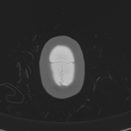 Normal CT skull (Radiopaedia 40798-43459 A 153).png