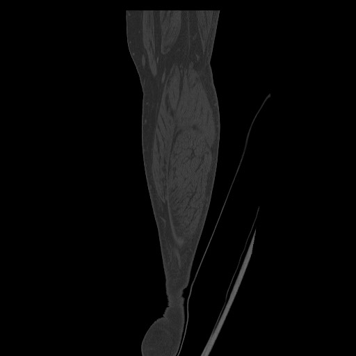 Normal CT tibia and fibula (Radiopaedia 51195-56848 Coronal non-contrast 61).jpg