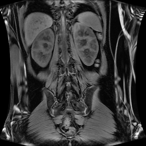 Normal MRI abdomen in pregnancy (Radiopaedia 88001-104541 M 106).jpg