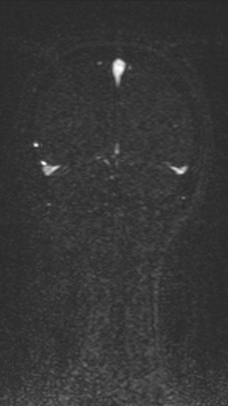 Normal MRI brain with MRV- teenager (Radiopaedia 49425-54553 Coronal MRV 202).jpg