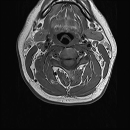File:Normal MRI cervical spine (infection protocol) (Radiopaedia 53916-60039 Axial 21).png