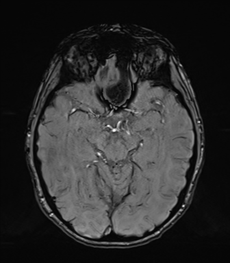 Normal brain MRI (TLE protocol) (Radiopaedia 40748-43405 Axial SWI 35).png