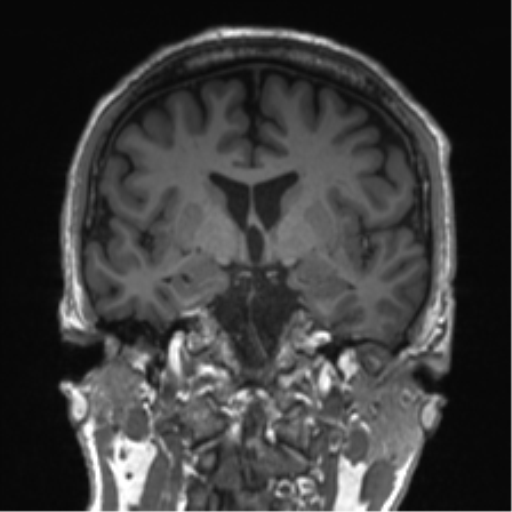 Normal brain MRI (non-focal epilepsy protocol) (Radiopaedia 53917-60040 Coronal T1 38).png
