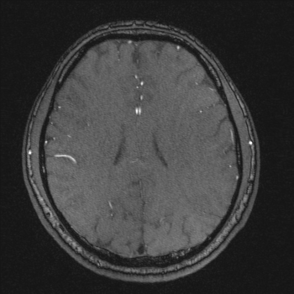 Normal brain MRI including MRA (Radiopaedia 48748-53763 Axial MRA 144).jpg