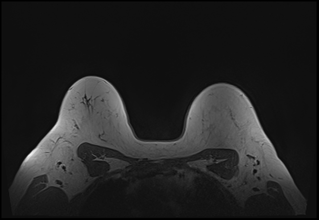 File:Normal breast MRI - dense breasts (Radiopaedia 80454-93850 Axial T1 181).jpg