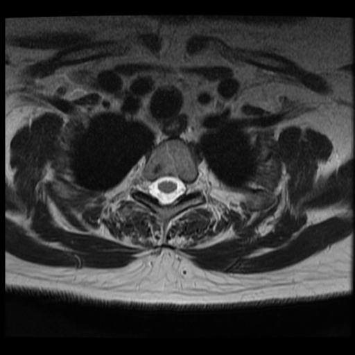 File:Normal cervical and thoracic spine MRI (Radiopaedia 35630-37156 Axial T2 4).png
