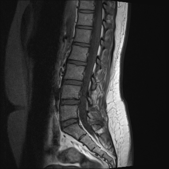 File:Normal lumbar spine MRI- 3 T (Radiopaedia 53280-59250 Sagittal T1 12).jpg