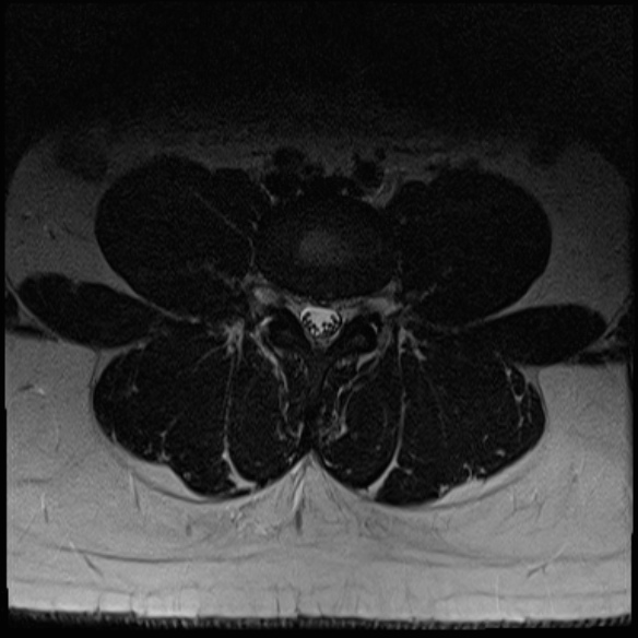 File:Normal lumbar spine MRI (Radiopaedia 47857-52609 Axial T2 15).jpg