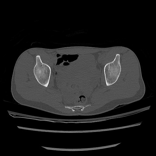 Normal pelvis CT (Radiopaedia 51471-57236 Axial bone window 61).jpg