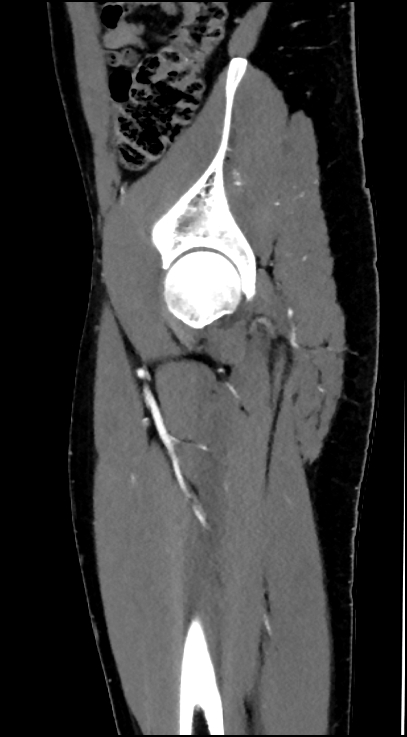 Normal pelvis CT angiogram (Radiopaedia 84966-100481 C 26).jpg