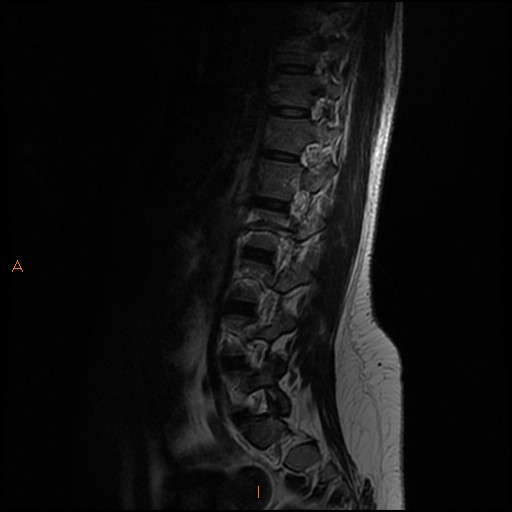 File:Normal spine MRI (Radiopaedia 77323-89408 Sagittal T2 4).jpg
