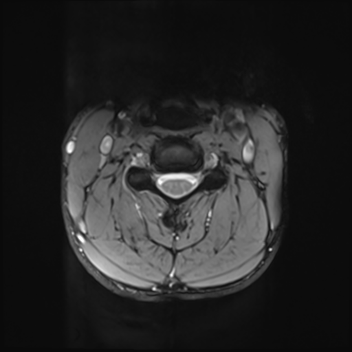 File:Normal trauma cervical spine (Radiopaedia 41017-43762 Axial T2 12).png
