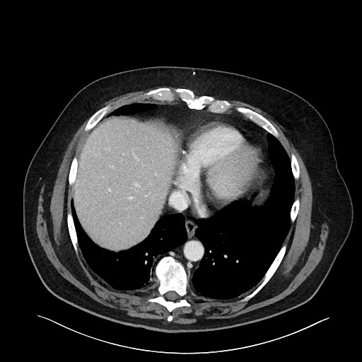 Obstructing sigmoid adenocarcinoma (Radiopaedia 58465-65619 A 20).jpg
