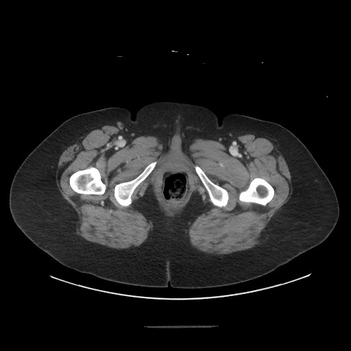 Obstructive distal colonic adenocarcinoma causing cecal perforation (Radiopaedia 86830-102989 A 202).jpg