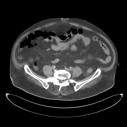 File:Obstructive pyelonephritis (Radiopaedia 46411-50844 Axial non-contrast 52).png