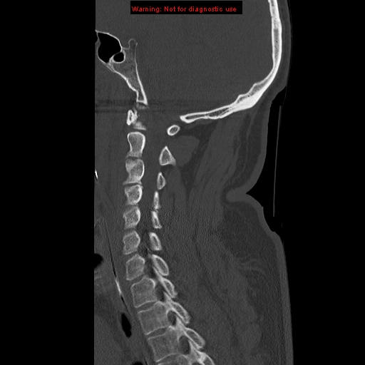 File:Occipital condyle fracture (Radiopaedia 18366-18208 Sagittal bone window 23).jpg