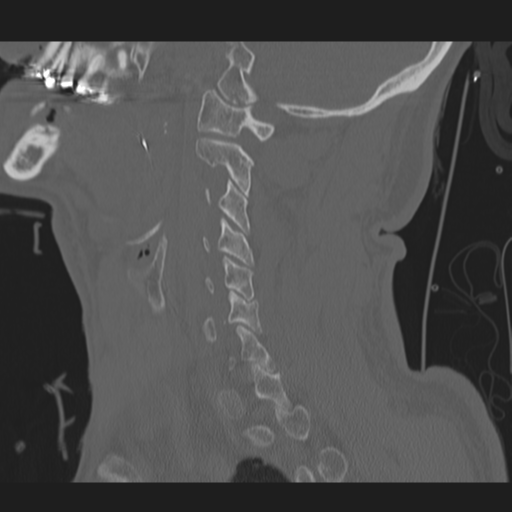 File:Occipital condyle fracture (Radiopaedia 33467-34517 Sagittal bone window 23).png