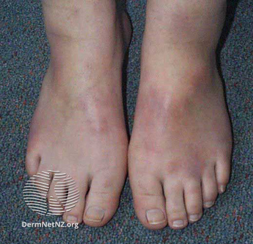 File:Panniculitis (DermNet NZ dermal-infiltrative-pan-feet).jpg