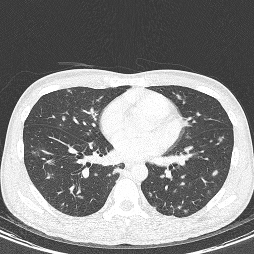 AIDS-related Kaposi sarcoma (Radiopaedia 85247-100811 Axial lung window 100).jpg