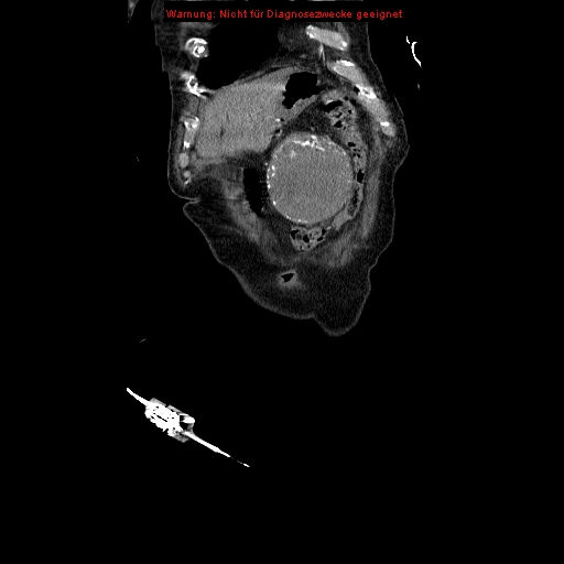 Abdominal aortic aneurysm- extremely large, ruptured (Radiopaedia 19882-19921 Coronal C+ arterial phase 13).jpg
