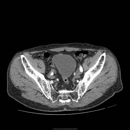 Abdominal aortic aneurysm (Radiopaedia 13341-13340 Axial C+ arterial phase 209).jpg