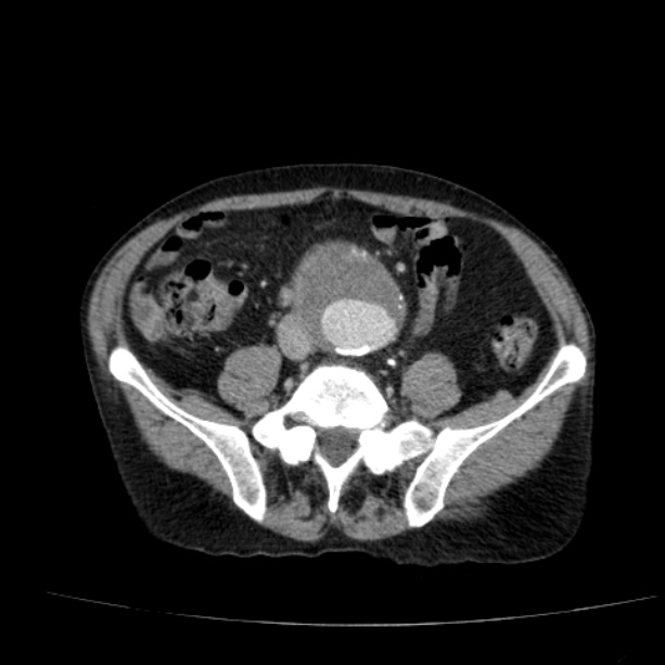 Abdominal aortic aneurysm (Radiopaedia 29248-29660 Axial C+ portal venous phase 41).jpg