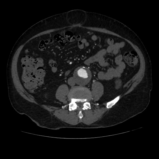 File:Abdominal aortic aneurysm (Radiopaedia 57318-64259 Axial C+ arterial phase 45).jpg