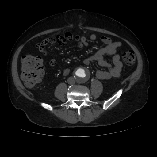 File:Abdominal aortic aneurysm (Radiopaedia 57318-64259 Axial C+ arterial phase 46).jpg