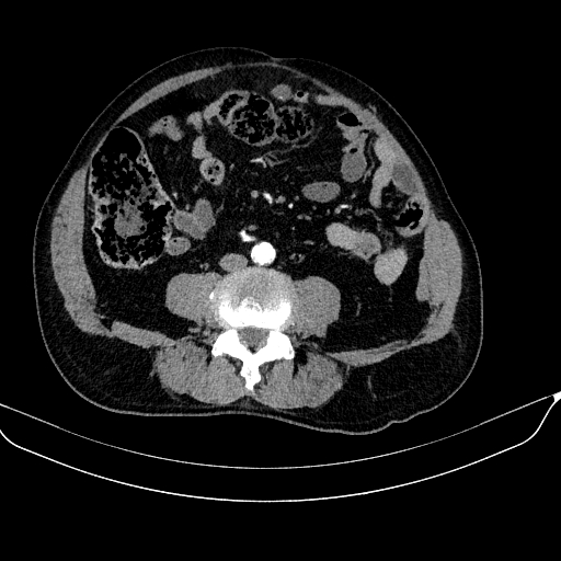 Abdominal aortic aneurysm (Radiopaedia 67117-76452 Axial C+ arterial phase 83).jpg