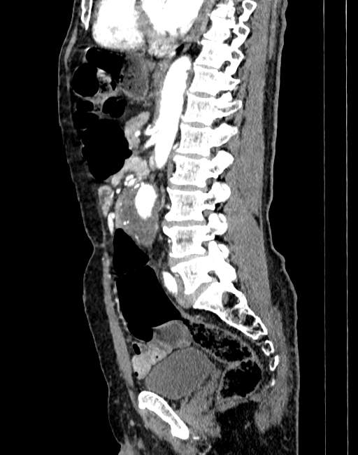 Abdominal aortic aneurysm (Radiopaedia 83581-98689 Sagittal C+ arterial phase 55).jpg