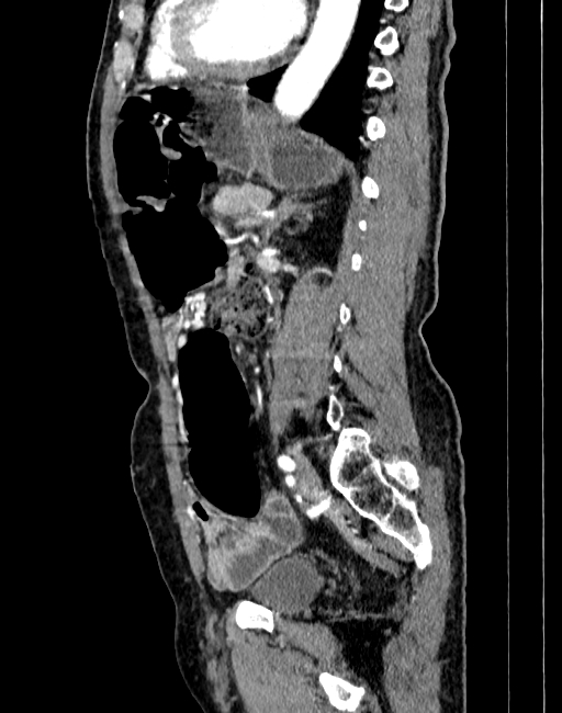 Abdominal aortic aneurysm (Radiopaedia 83581-98689 Sagittal C+ arterial phase 69).jpg