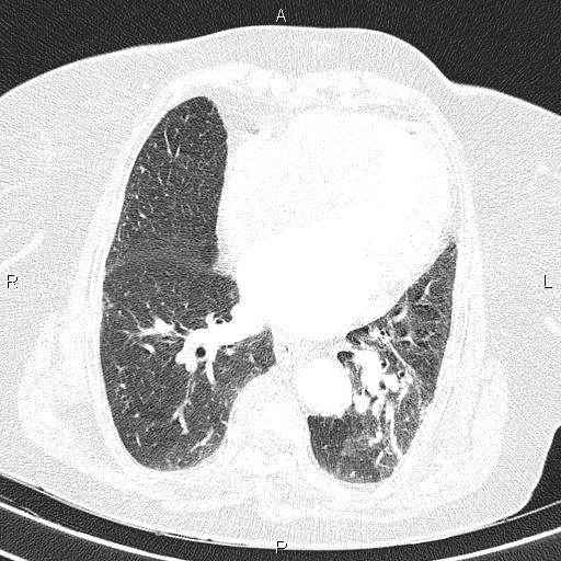 Abdominal aortic aneurysm (Radiopaedia 85063-100606 Axial lung window 42).jpg