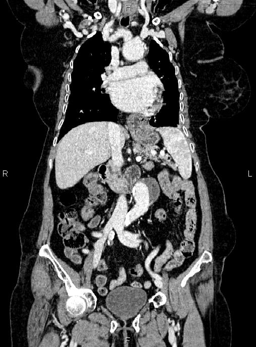 Abdominal aortic aneurysm (Radiopaedia 85063-100606 Coronal C+ arterial phase 25).jpg