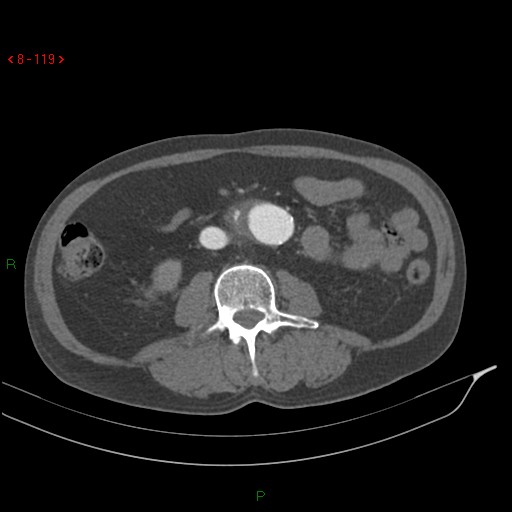 Abdominal aortic aneurysm rupture with aortocaval fistula (Radiopaedia 14897-14841 Axial C+ arterial phase 119).jpg