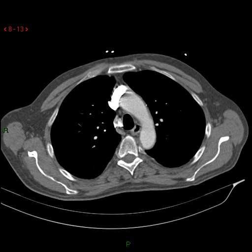 Abdominal aortic aneurysm rupture with aortocaval fistula (Radiopaedia 14897-14841 Axial C+ arterial phase 13).jpg