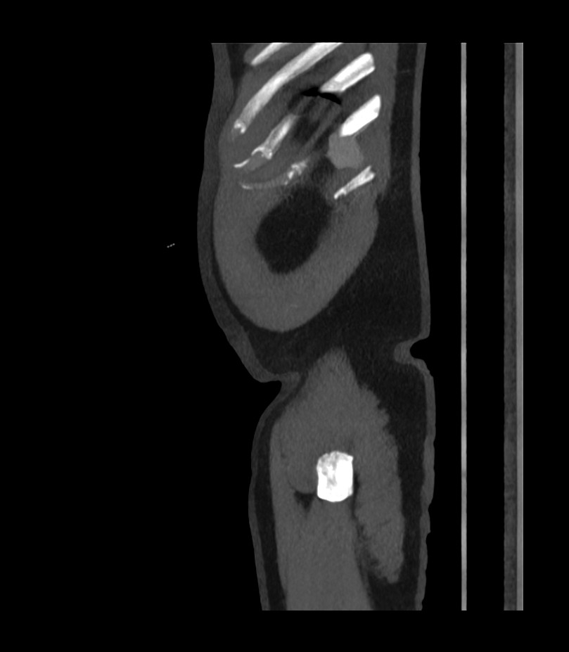 Abdominal aortic aneurysm with thrombus fissuration (Radiopaedia 46218-50618 Sagittal C+ arterial phase 57).jpg