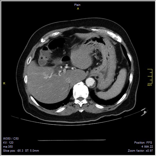Abdominal aortic aneurysm with thrombus fissuration (Radiopaedia 47340-51926 Axial C+ arterial phase 6).jpg