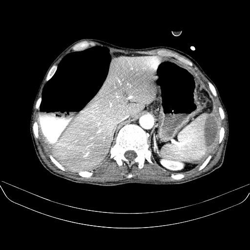 File:Abdominal collection due to previous cecal perforation (Radiopaedia 80831-94320 Axial C+ portal venous phase 43).jpg